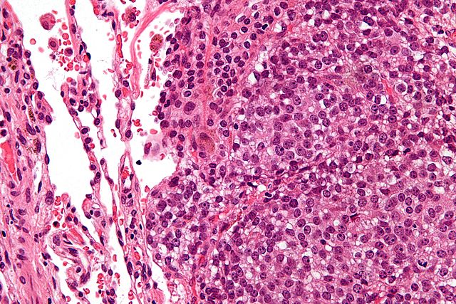 Sarcoma di Ewing e tumori solidi