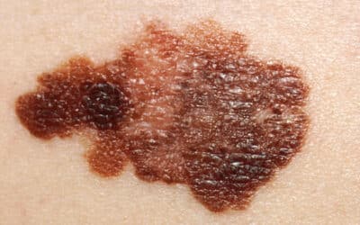 Melanoma: un selfie non basta a combatterlo