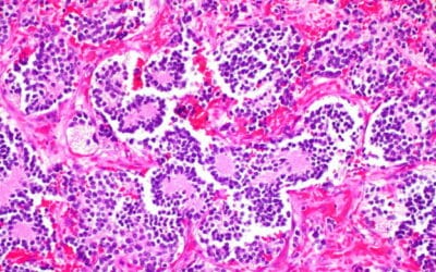 Neuroblastoma: il punto sulla ricerca