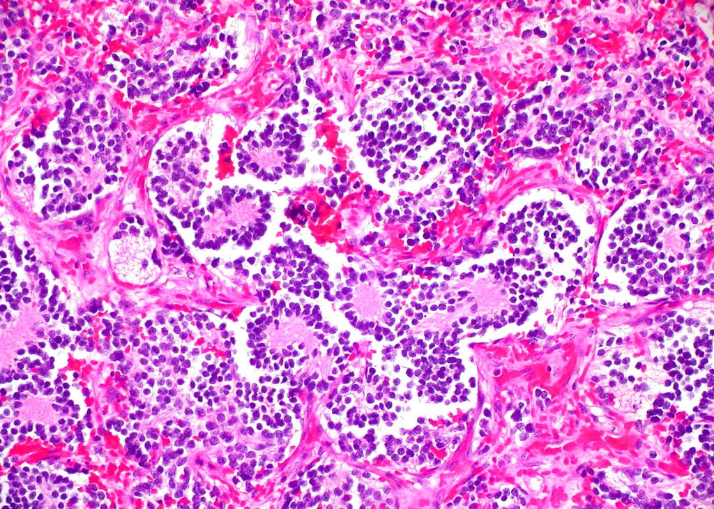 Il punto della ricerca scientifica sul neuroblastoma