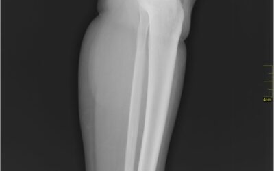Il sarcoma: conoscerlo per sconfiggerlo